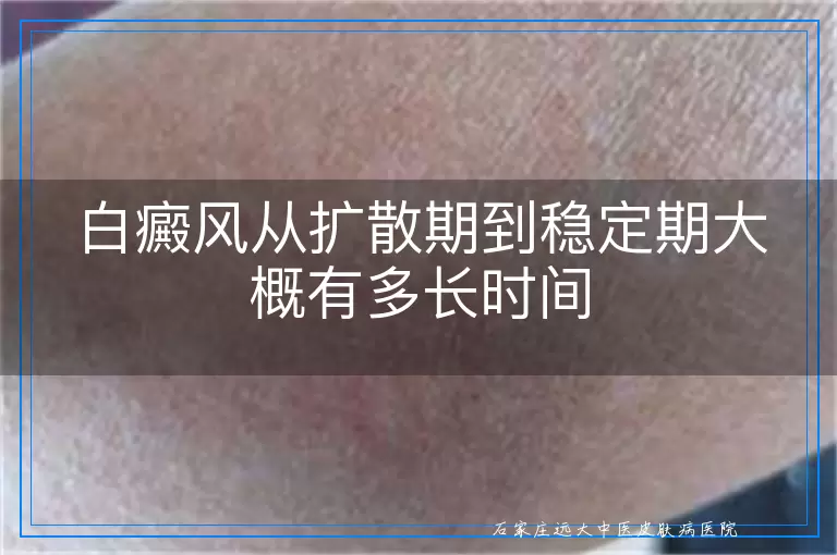 白癜风从扩散期到稳定期大概有多长时间
