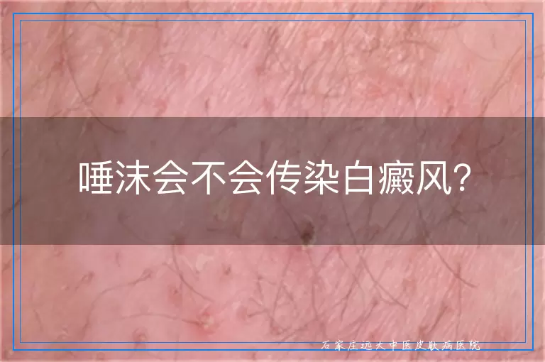 唾沫会不会传染白癜风？