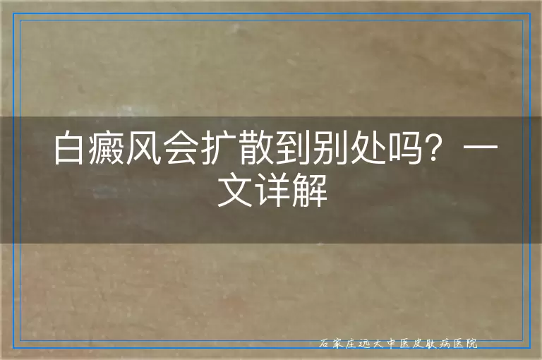 白癜风会扩散到别处吗？一文详解