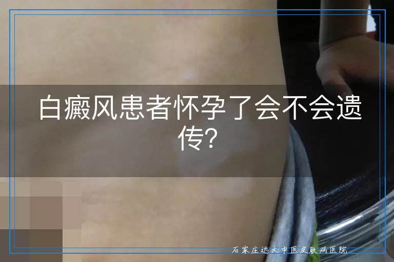 白癜风患者怀孕了会不会遗传？