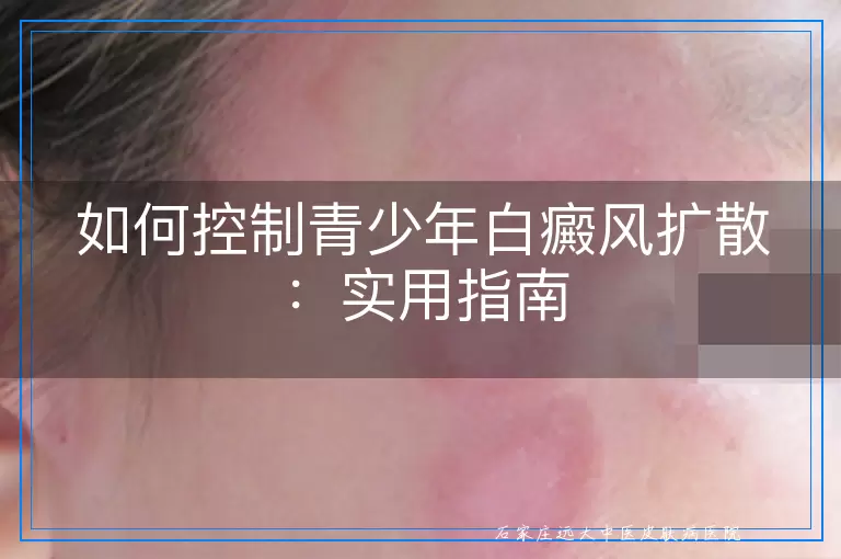 如何控制青少年白癜风扩散：实用指南