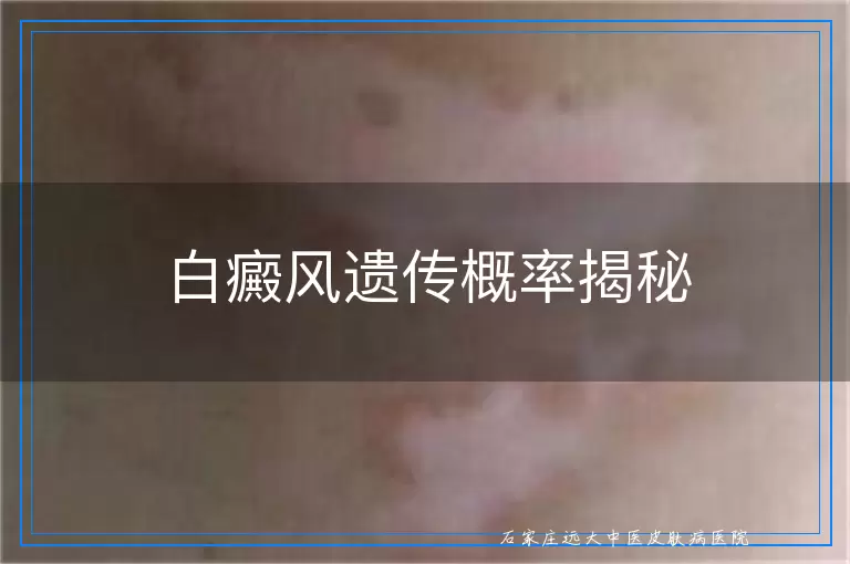 白癜风遗传概率揭秘