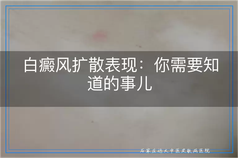 白癜风扩散表现：你需要知道的事儿