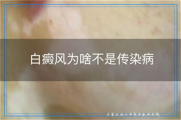 白癜风为啥不是传染病