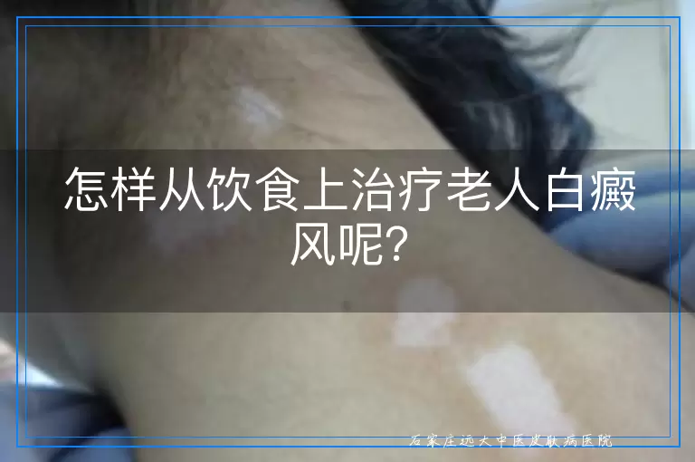 怎样从饮食上治疗老人白癜风呢？