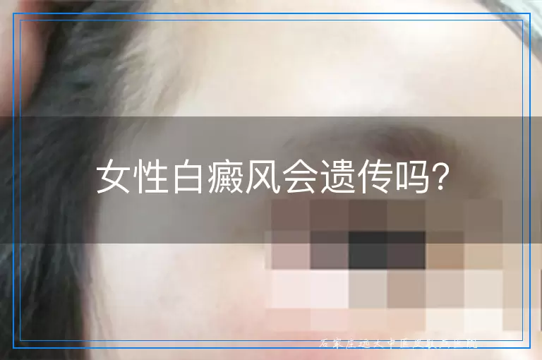 女性白癜风会遗传吗？