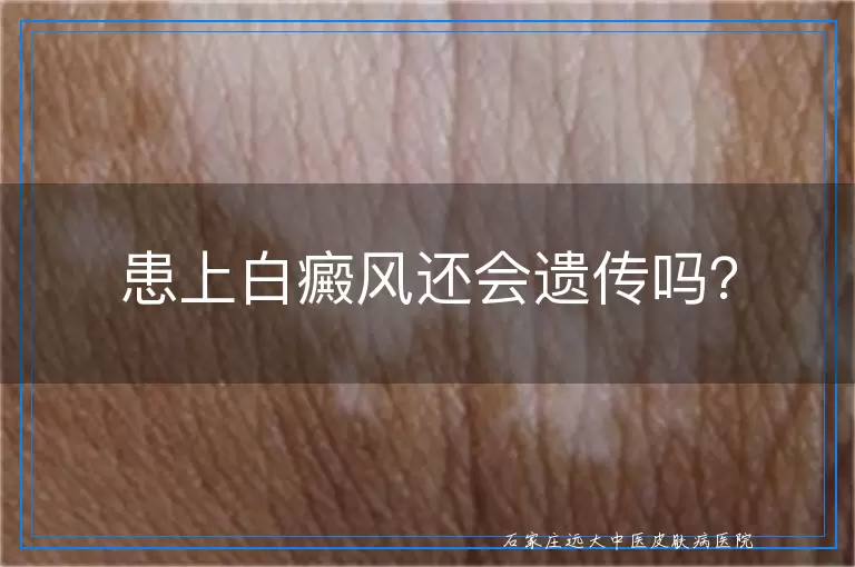 患上白癜风还会遗传吗？