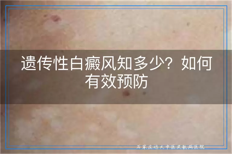 遗传性白癜风知多少？如何有效预防