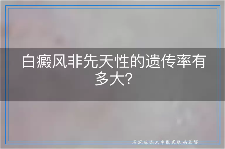 白癜风非先天性的遗传率有多大？