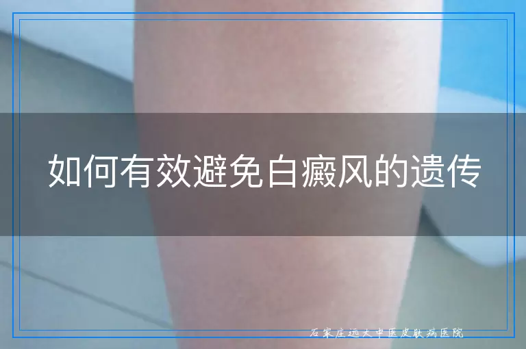 如何有效避免白癜风的遗传