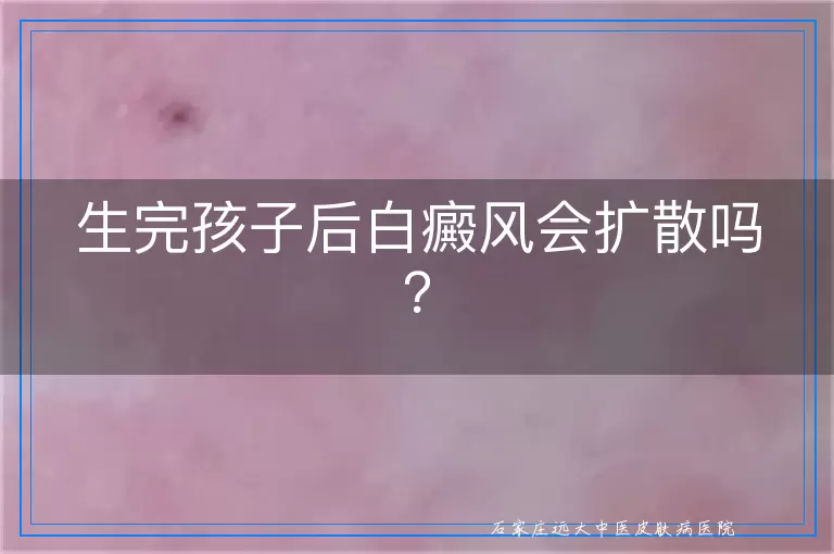 生完孩子后白癜风会扩散吗？