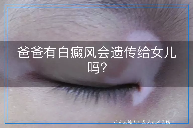 爸爸有白癜风会遗传给女儿吗？