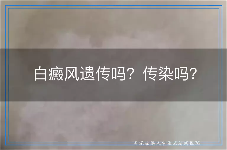 白癜风遗传吗？传染吗？