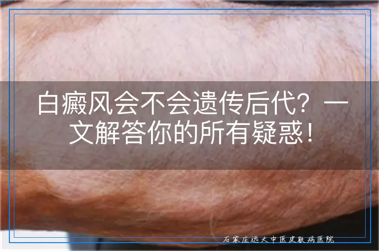 白癜风会不会遗传后代？一文解答你的所有疑惑！