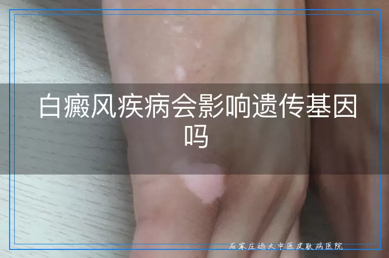 白癜风疾病会影响遗传基因吗
