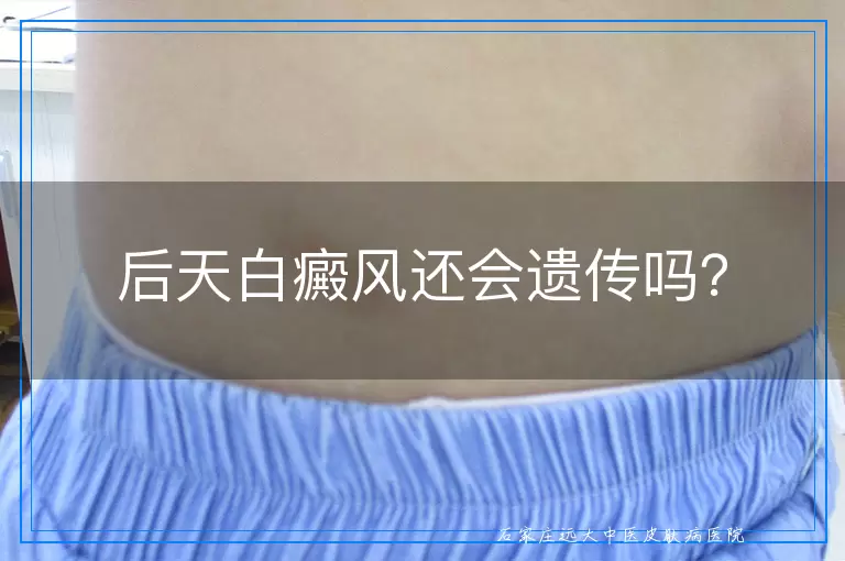 后天白癜风还会遗传吗？