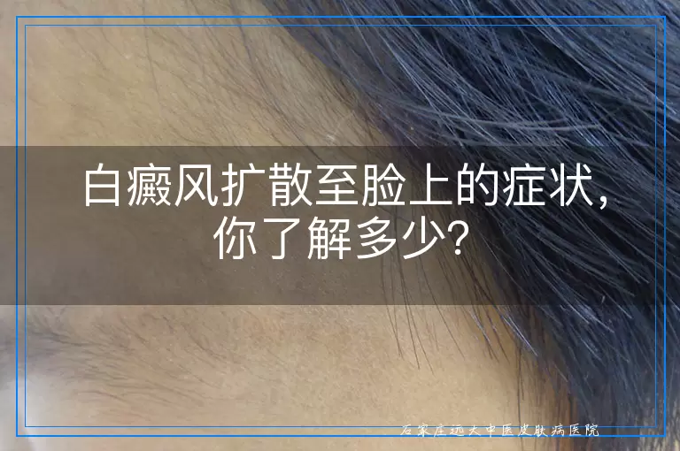 白癜风扩散至脸上的症状，你了解多少？