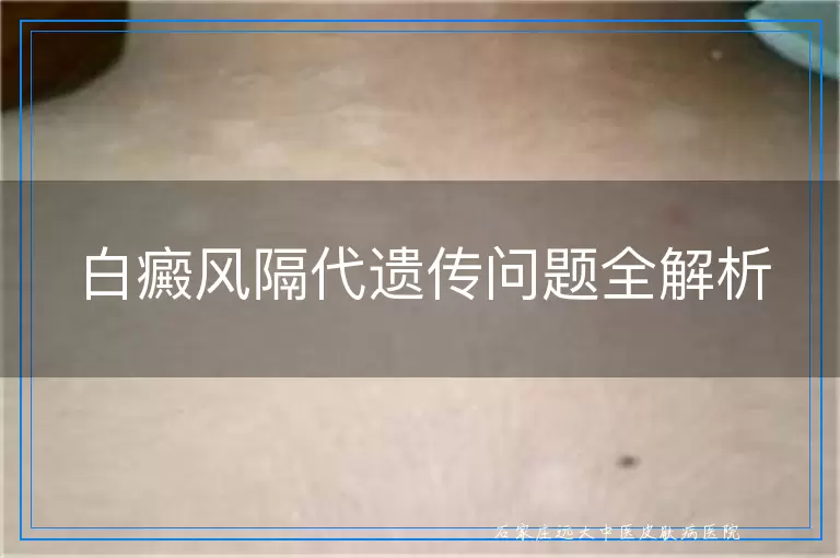 白癜风隔代遗传问题全解析