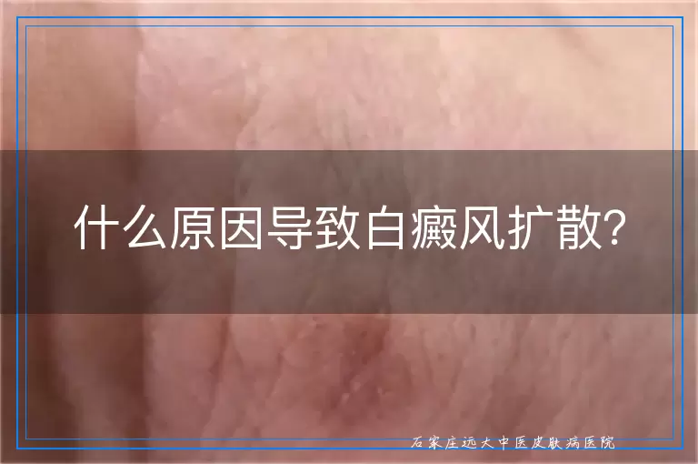 什么原因导致白癜风扩散？