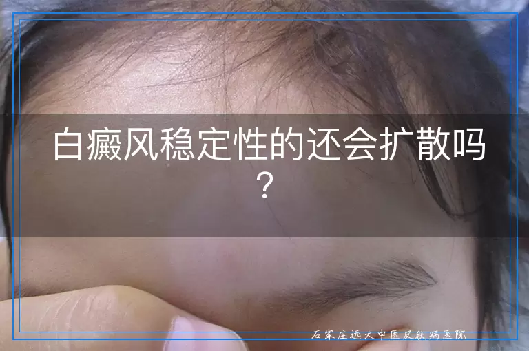 白癜风稳定性的还会扩散吗？