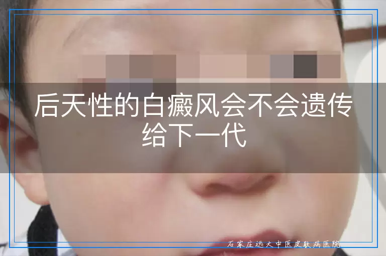 后天性的白癜风会不会遗传给下一代