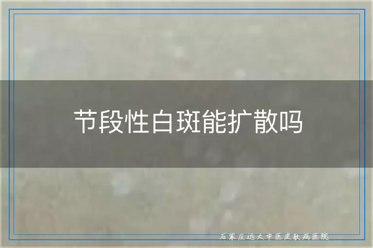 节段性白斑能扩散吗