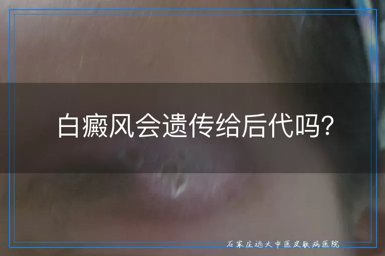白癜风会遗传给后代吗？