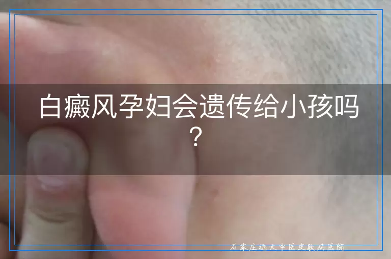 白癜风孕妇会遗传给小孩吗？