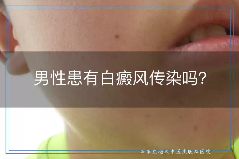 男性患有白癜风传染吗？