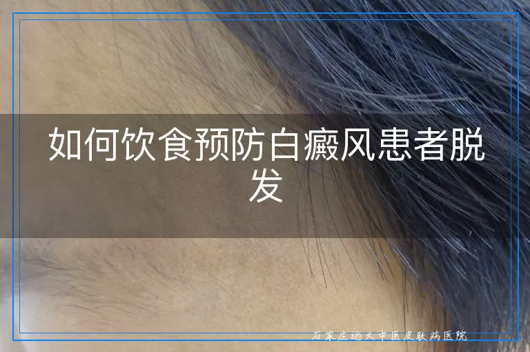 如何饮食预防白癜风患者脱发