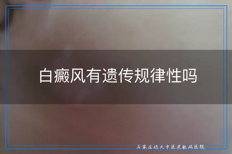 白癜风有遗传规律性吗