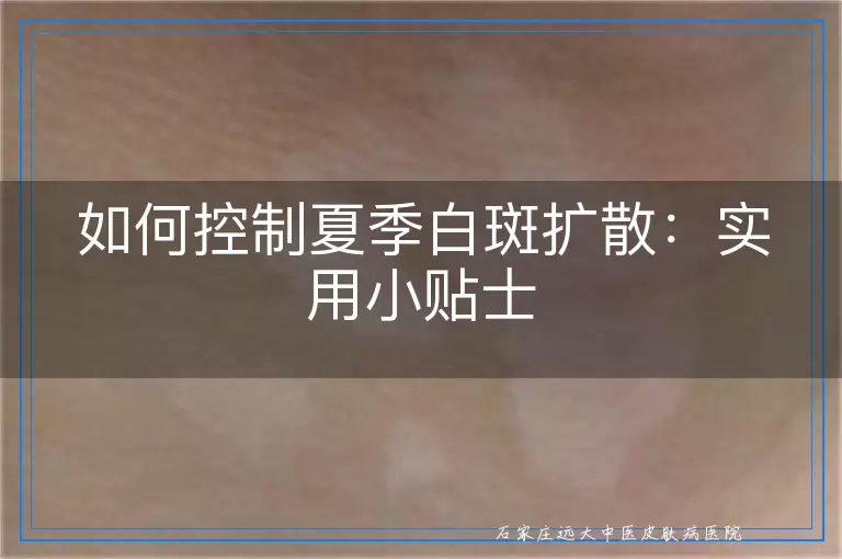 如何控制夏季白斑扩散：实用小贴士