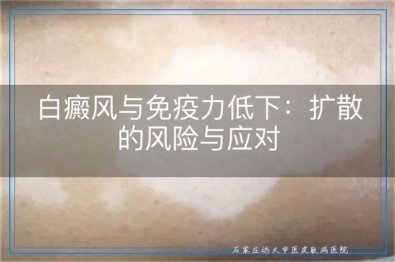 白癜风与免疫力低下：扩散的风险与应对