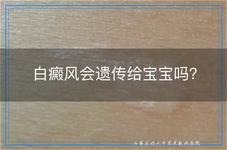 白癜风会遗传给宝宝吗？