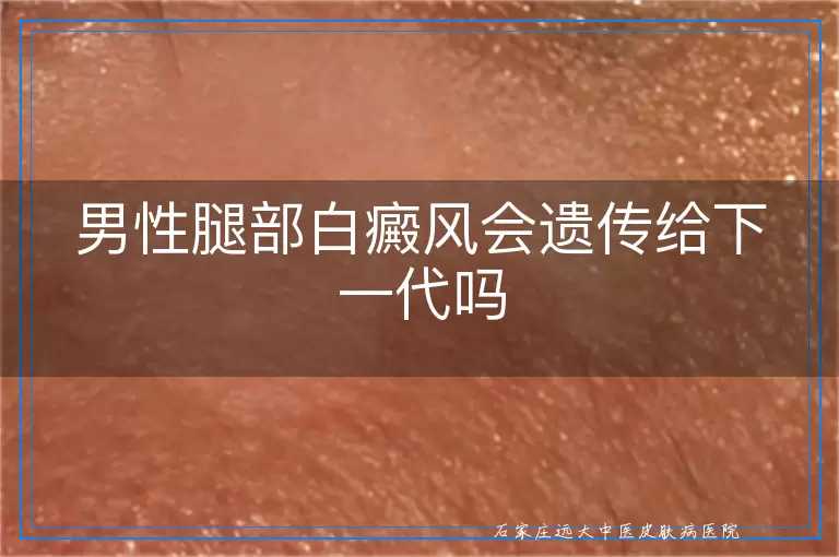 男性腿部白癜风会遗传给下一代吗