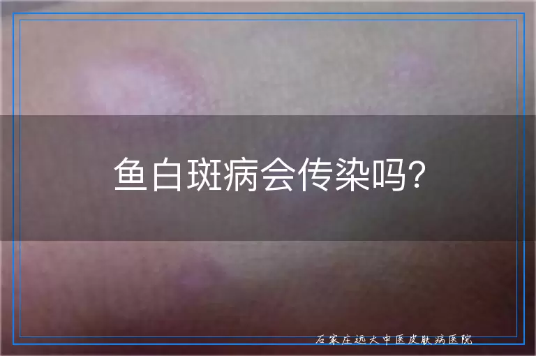 鱼白斑病会传染吗？