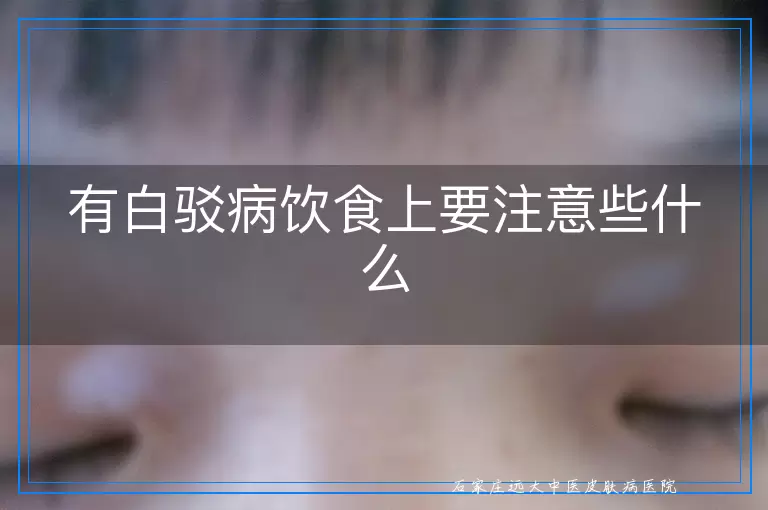 有白驳病饮食上要注意些什么