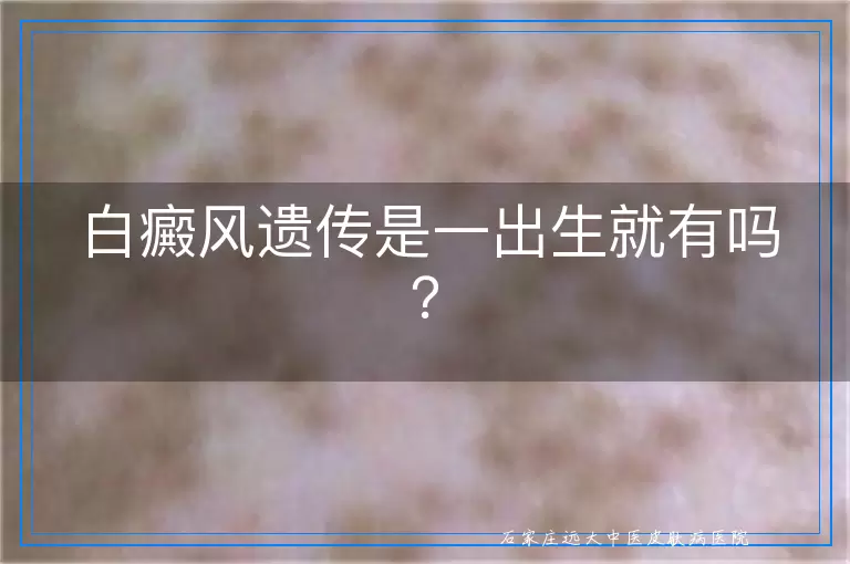 白癜风遗传是一出生就有吗？