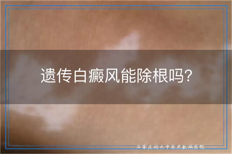 遗传白癜风能除根吗？