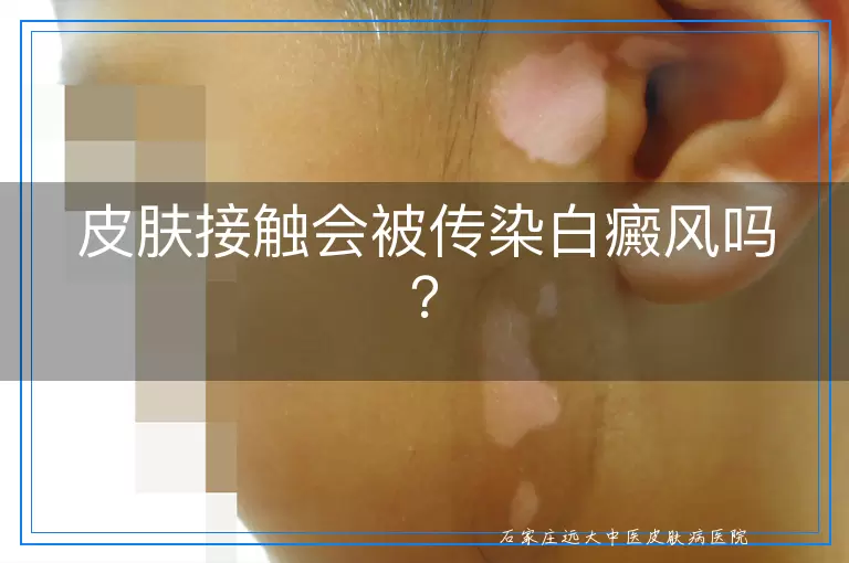 皮肤接触会被传染白癜风吗？