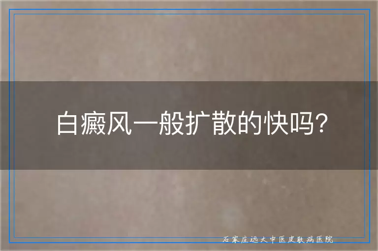 白癜风一般扩散的快吗？