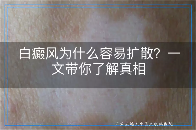 白癜风为什么容易扩散？一文带你了解真相