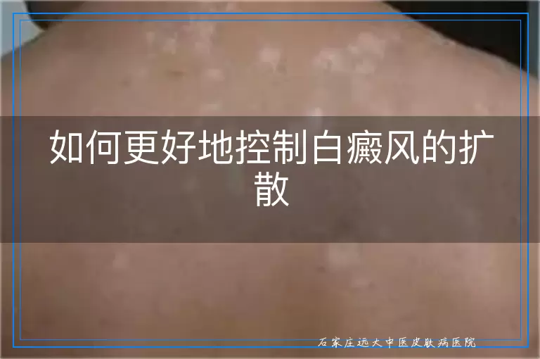 如何更好地控制白癜风的扩散