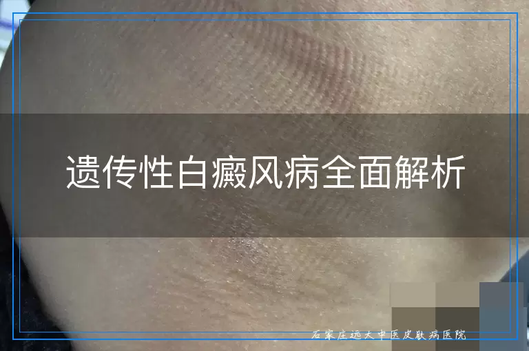 遗传性白癜风病全面解析