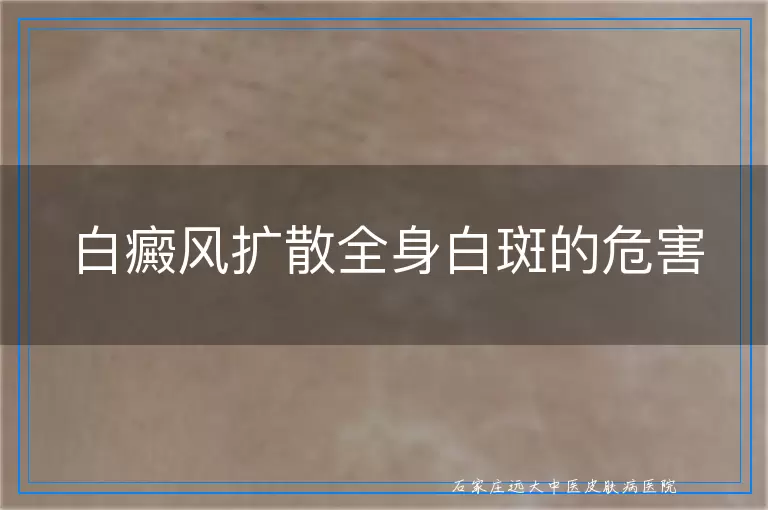 白癜风扩散全身白斑的危害