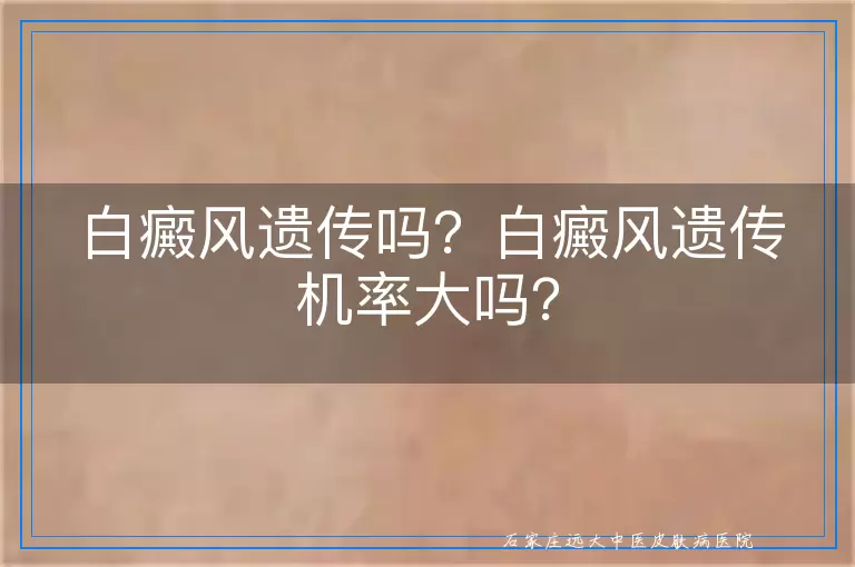 白癜风遗传吗？白癜风遗传机率大吗？