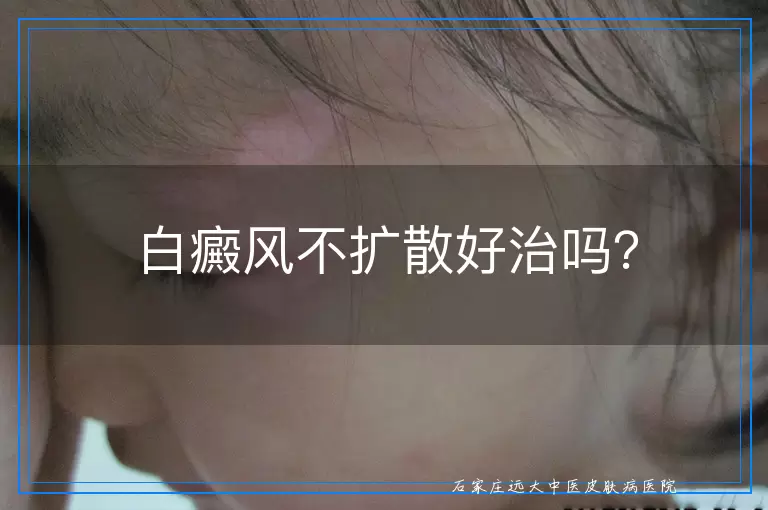 白癜风不扩散好治吗？