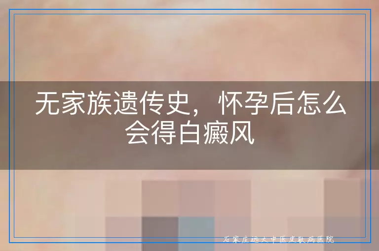 无家族遗传史，怀孕后怎么会得白癜风