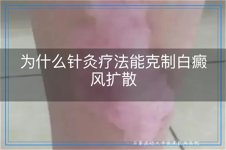 为什么针灸疗法能克制白癜风扩散