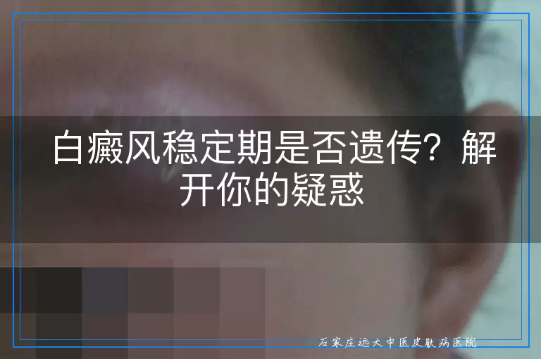 白癜风稳定期是否遗传？解开你的疑惑